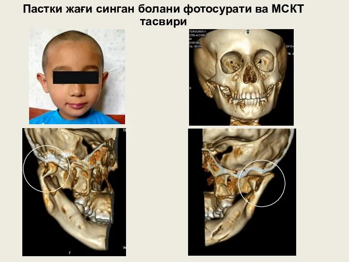 Пастки жағи синган болани фотосурати ва МСКТ тасвири