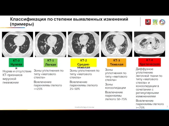 medradiology.moscow Классификация по степени выявленных изменений (примеры) КТ-0 Нулевая КТ-1 Легкая