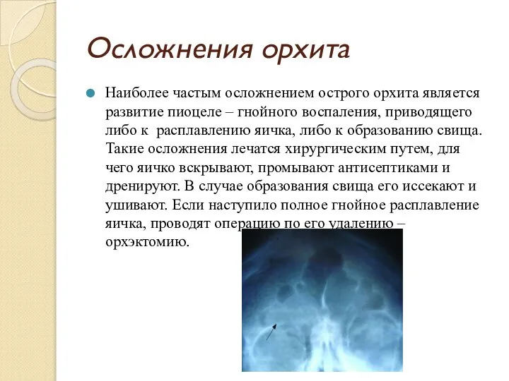 Осложнения орхита Наиболее частым осложнением острого орхита является развитие пиоцеле –