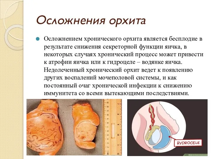 Осложнения орхита Осложнением хронического орхита является бесплодие в результате снижения секреторной