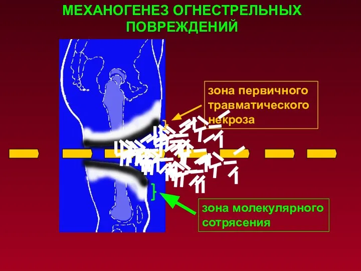 зона первичного травматического некроза зона молекулярного сотрясения МЕХАНОГЕНЕЗ ОГНЕСТРЕЛЬНЫХ ПОВРЕЖДЕНИЙ