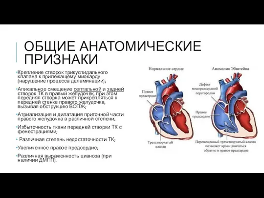 ОБЩИЕ АНАТОМИЧЕСКИЕ ПРИЗНАКИ Крепление створок трикуспидального клапана к прилежащему миокарду (нарушение