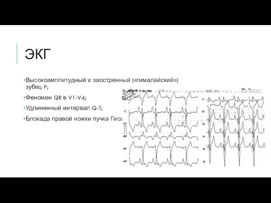 ЭКГ Высокоамплитудный и заостренный («гималайский») зубец P; Феномен QR в V1-V4;