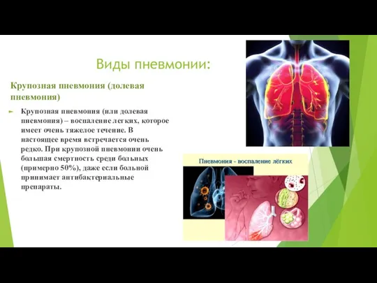 Виды пневмонии: Крупозная пневмония (долевая пневмония) Крупозная пневмония (или долевая пневмония)