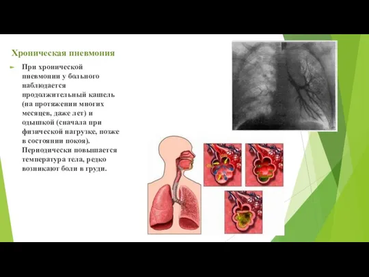 Хроническая пневмония При хронической пневмонии у больного наблюдается продолжительный кашель (на