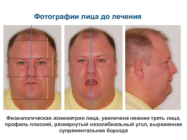 Физиологическая асимметрия лица, увеличена нижняя треть лица, профиль плоский, развернутый назолабиальный