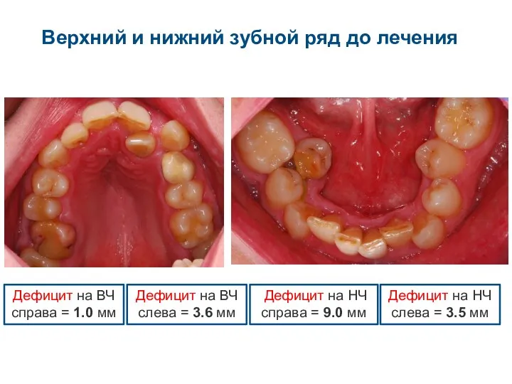 Верхний и нижний зубной ряд до лечения Дефицит на НЧ справа