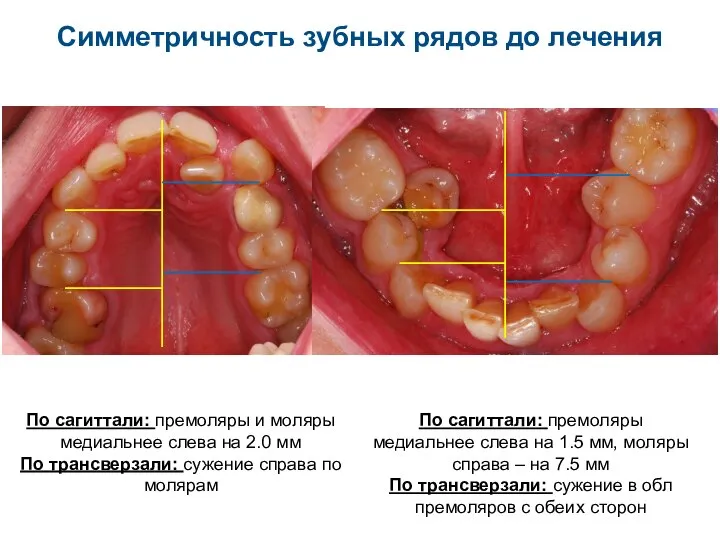 Симметричность зубных рядов до лечения По сагиттали: премоляры и моляры медиальнее