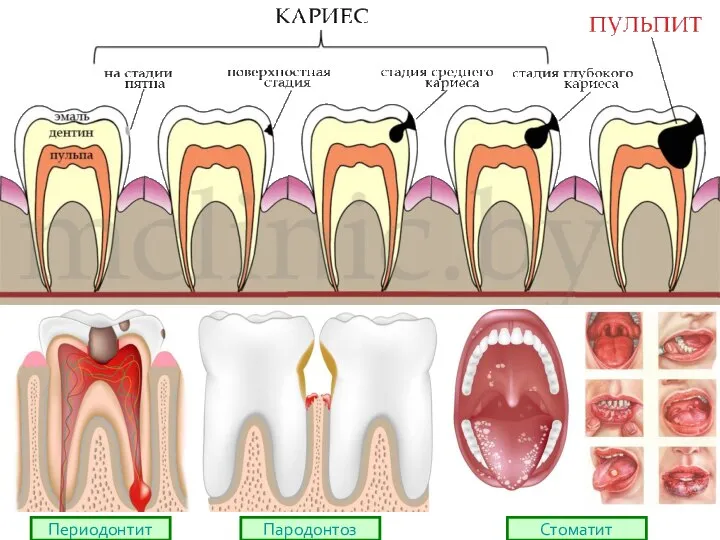 Периодонтит Пародонтоз Стоматит
