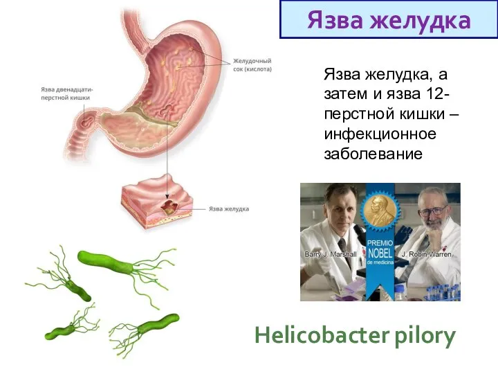 Язва желудка, а затем и язва 12-перстной кишки – инфекционное заболевание Язва желудка Helicobacter pilory
