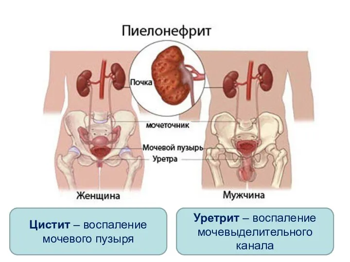 Цистит – воспаление мочевого пузыря Уретрит – воспаление мочевыделительного канала