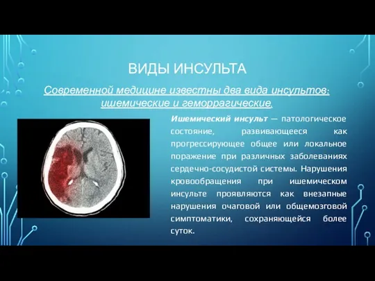 ВИДЫ ИНСУЛЬТА Ишемический инсульт — патологическое состояние, развивающееся как прогрессирующее общее