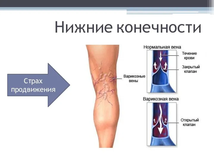 Нижние конечности Страх продвижения