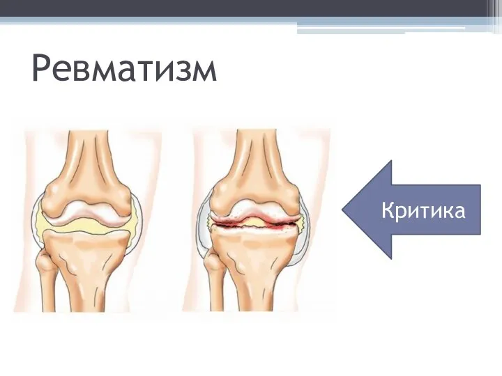 Ревматизм Критика