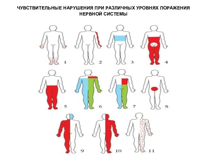 ЧУВСТВИТЕЛЬНЫЕ НАРУШЕНИЯ ПРИ РАЗЛИЧНЫХ УРОВНЯХ ПОРАЖЕНИЯ НЕРВНОЙ СИСТЕМЫ