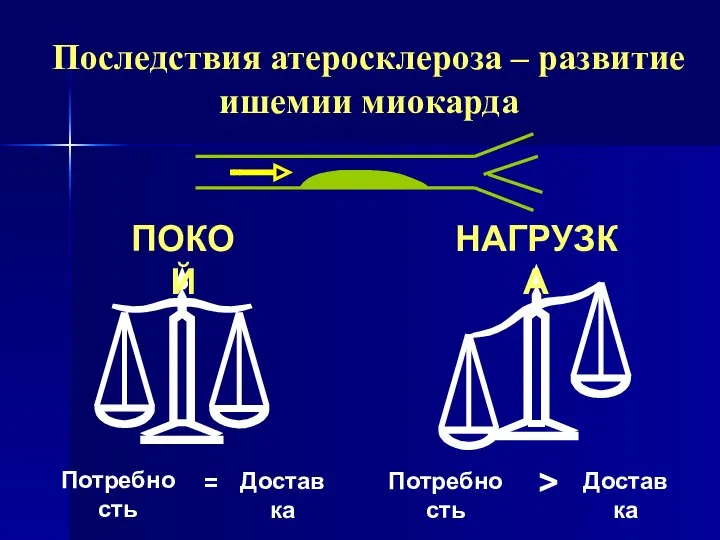 Последствия атеросклероза – развитие ишемии миокарда Потребность = Доставка Потребность > Доставка ПОКОЙ НАГРУЗКА