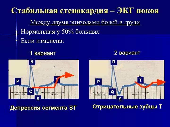 Стабильная стенокардия – ЭКГ покоя Между двумя эпизодами болей в груди