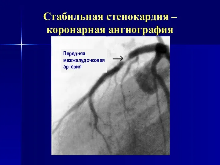 Стабильная стенокардия – коронарная ангиография Передняя межжелудочковая артерия