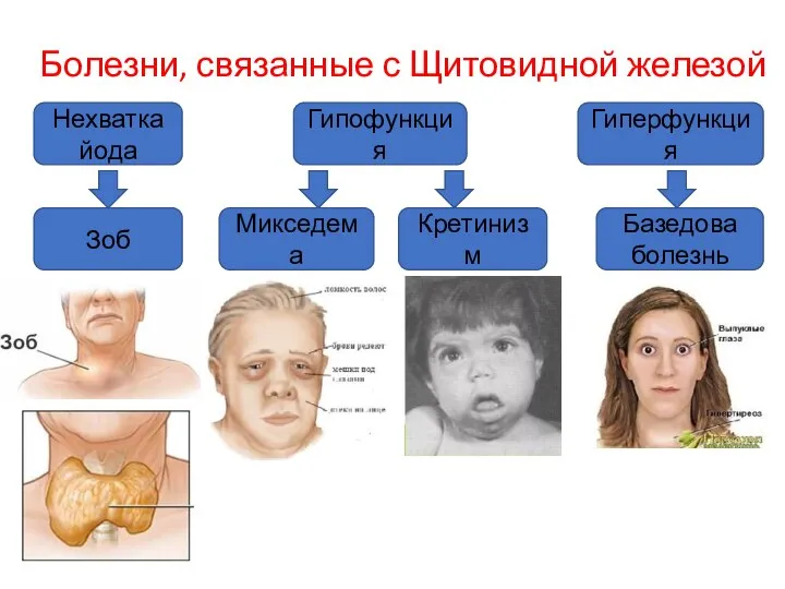 Болезни, связанные с Щитовидной железой Зоб Гиперфункция Гипофункция Нехватка йода Базедова болезнь Микседема Кретинизм