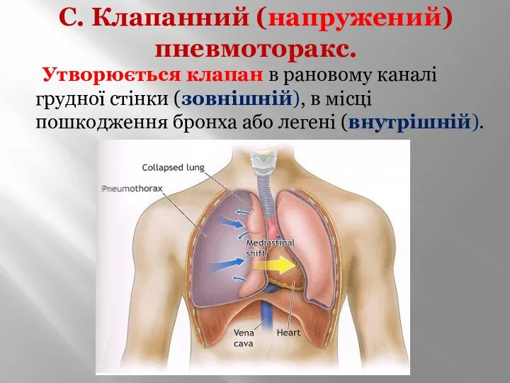 С. Клапанний (напружений) пневмоторакс. Утворюється клапан в рановому каналі грудної стінки