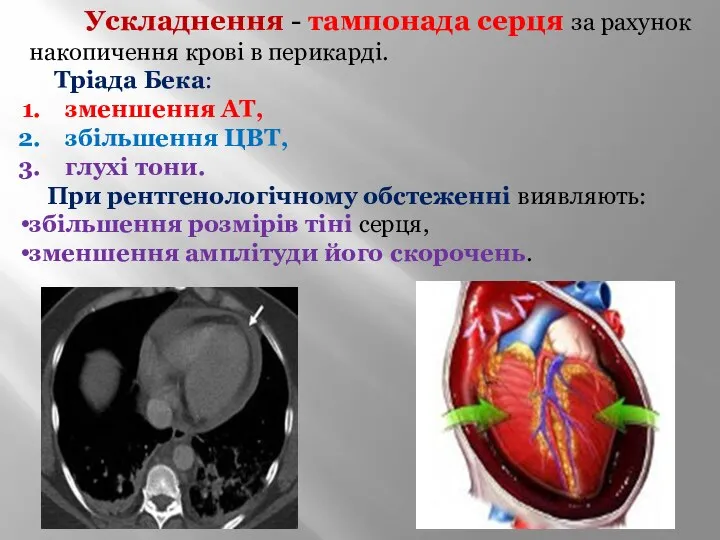 Ускладнення - тампонада серця за рахунок накопичення крові в перикарді. Тріада