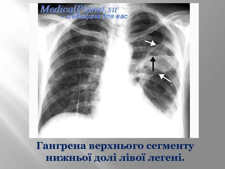 Гангрена верхнього сегменту нижньої долі лівої легені.