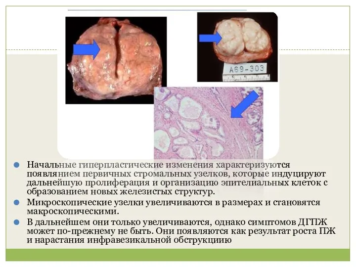 Начальные гиперпластические изменения характеризуются появлянием первичных стромальных узелков, которые индуцируют дальнейшую