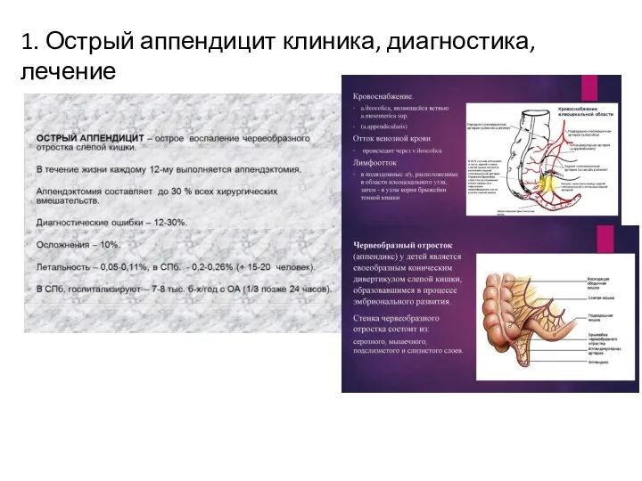 1. Острый аппендицит клиника, диагностика, лечение