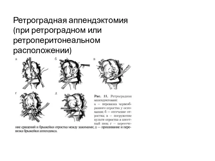 Ретроградная аппендэктомия (при ретроградном или ретроперитонеальном расположении)