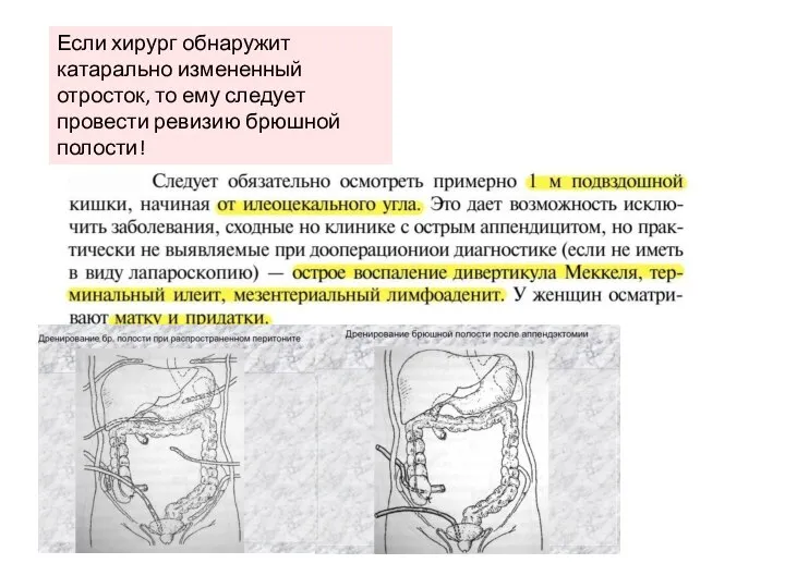 Если хирург обнаружит катарально измененный отросток, то ему следует провести ревизию брюшной полости!