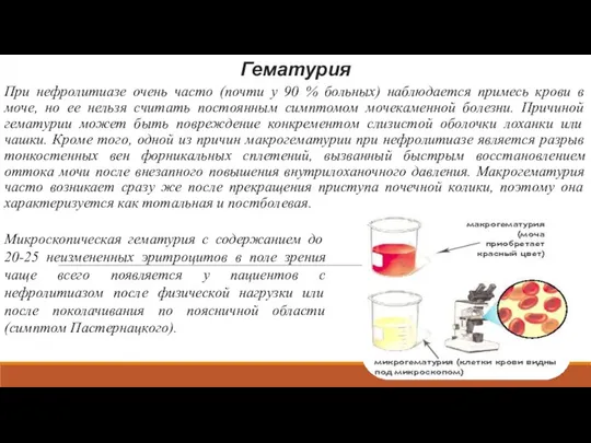 Гематурия При нефролитиазе очень часто (почти у 90 % больных) наблюдается