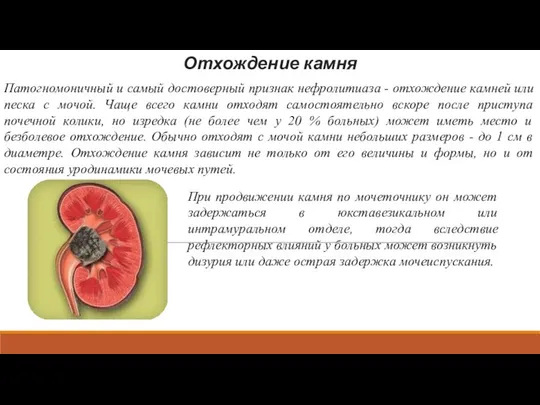 Отхождение камня Патогномоничный и самый достоверный признак нефролитиаза - отхождение камней