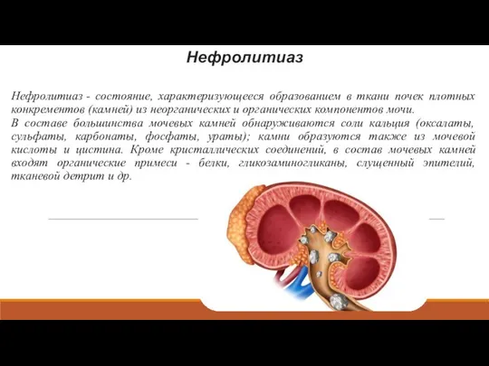 Нефролитиаз Нефролитиаз - состояние, характеризующееся образованием в ткани почек плотных конкрементов