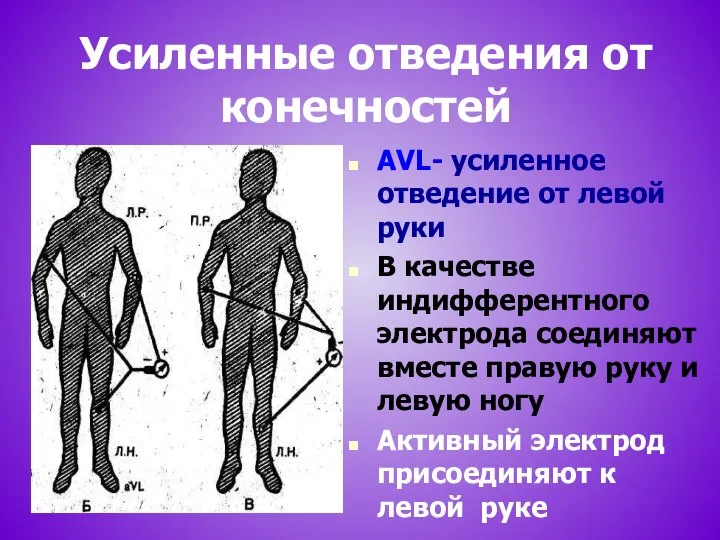 Усиленные отведения от конечностей АVL- усиленное отведение от левой руки В