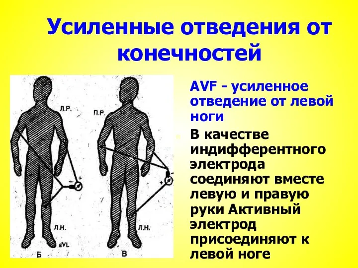 Усиленные отведения от конечностей АVF - усиленное отведение от левой ноги