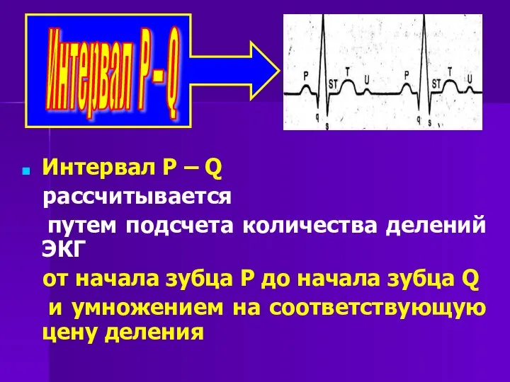 Интервал Р – Q рассчитывается путем подсчета количества делений ЭКГ от