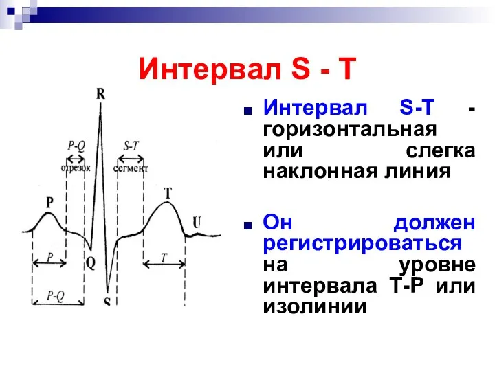 Интервал S - Т Интервал S-Т - горизонтальная или слегка наклонная