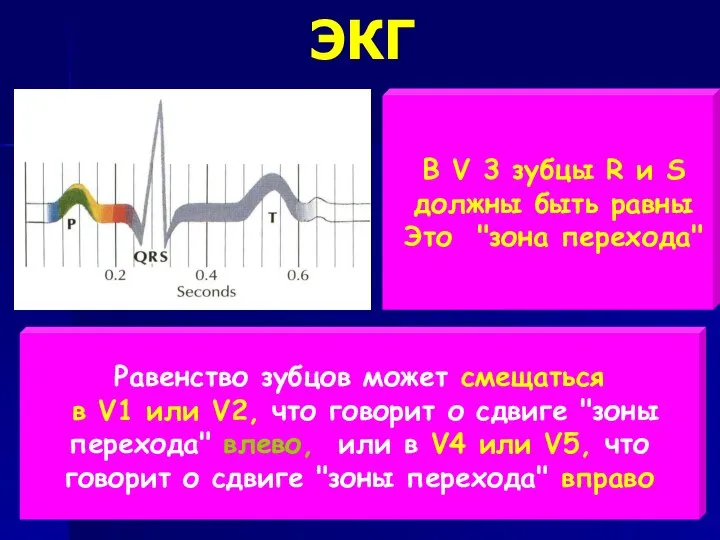 ЭКГ В V 3 зубцы R и S должны быть равны