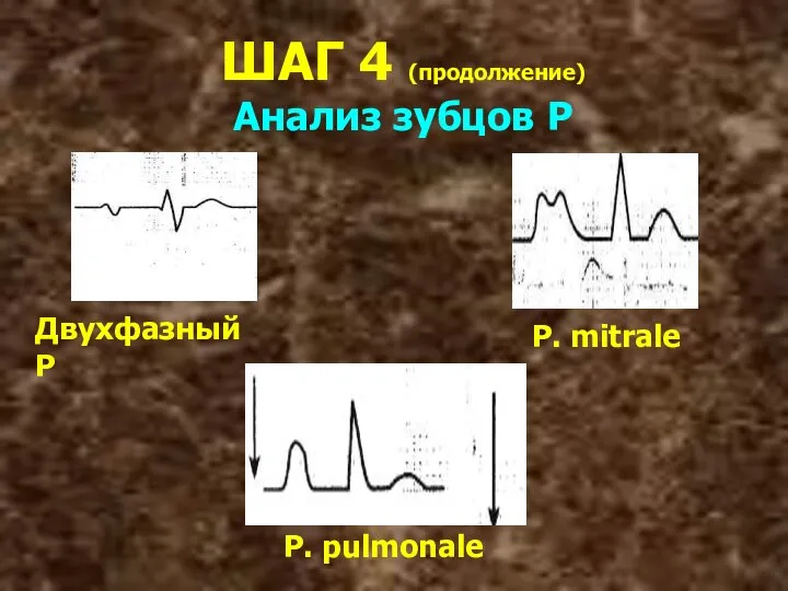 ШАГ 4 (продолжение) Анализ зубцов Р Двухфазный Р P. mitrale P. pulmonale