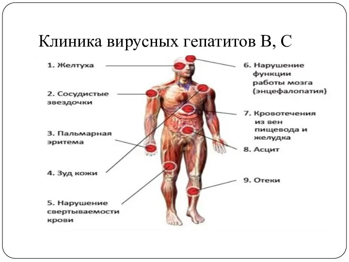 Клиника вирусных гепатитов В, С