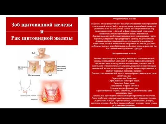 Зоб щитовидной железы Под зобом в медицине понимают все доброкачественные новообразования