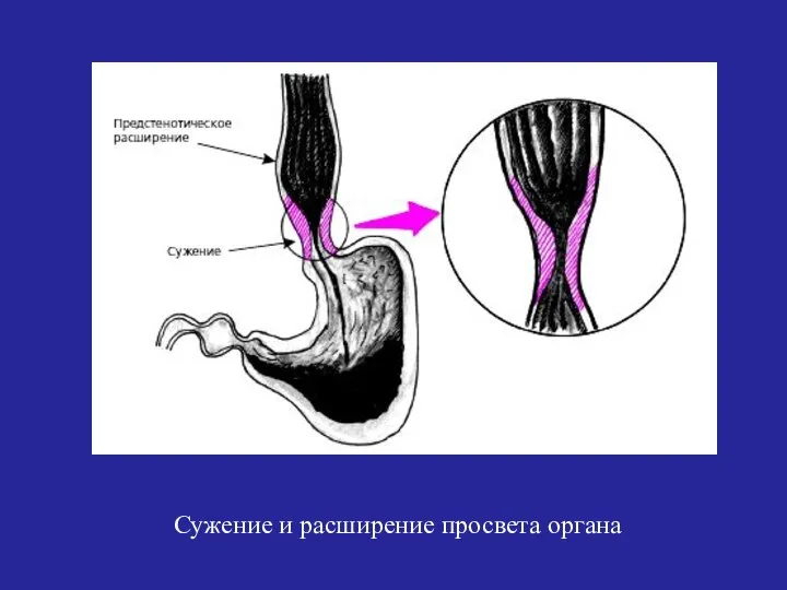 Сужение и расширение просвета органа