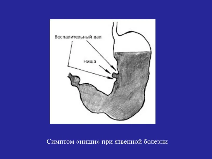 Симптом «ниши» при язвенной болезни