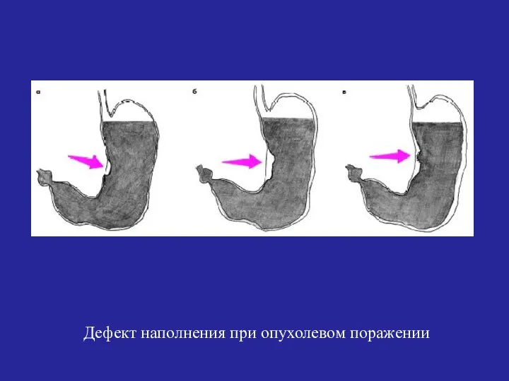 Дефект наполнения при опухолевом поражении