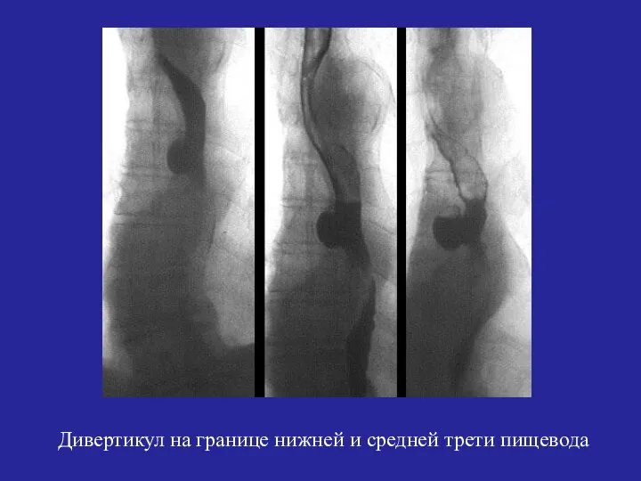 Дивертикул на границе нижней и средней трети пищевода