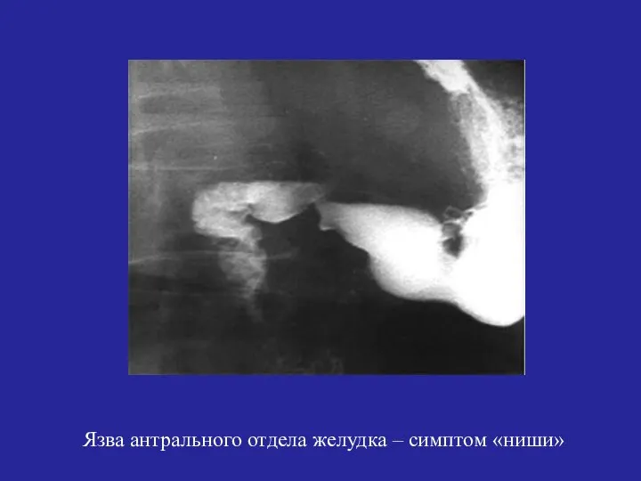 Язва антрального отдела желудка – симптом «ниши»