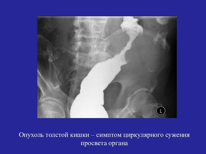 Опухоль толстой кишки – симптом циркулярного сужения просвета органа