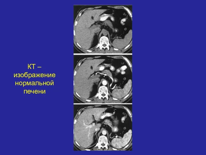 КТ – изображение нормальной печени