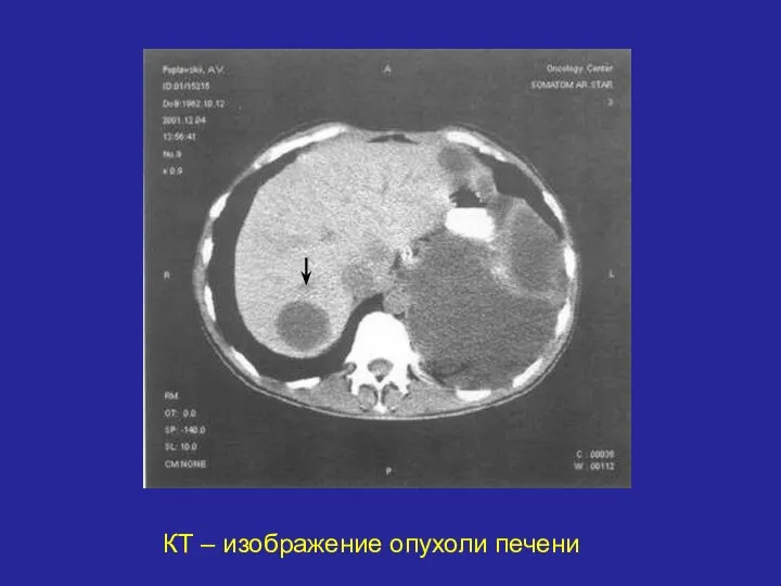 КТ – изображение опухоли печени