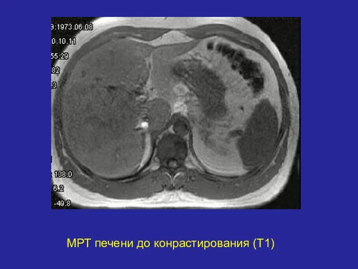 МРТ печени до конрастирования (Т1)